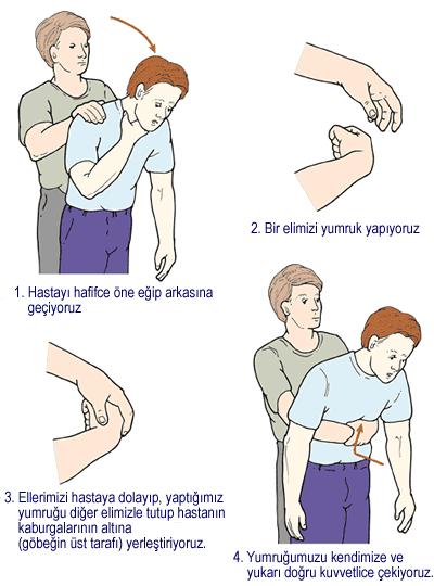 ġekil 4. Karına Bası (Heimlich manevrası) ERC (2005) den alınmıģtır (30). Kazadede arkasından kollar ile sarılıp öne doğru eğdirilir.