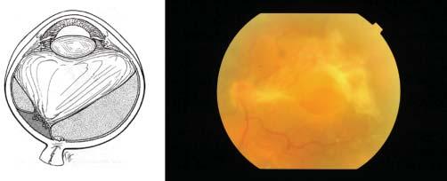 Ret-Vit 2008;16:85-90 Kapran ve ark. 87 Resim 1: Proliferatif diabetik retinopatide vitreoretinal yapışıklık- Tip 1:Total AVD.