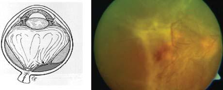 Resim 3: Proliferatif diabetik retinopatide vitreoretinal yapışıklık- Tip 3: Geniş vitreoretinal yapışıklık.