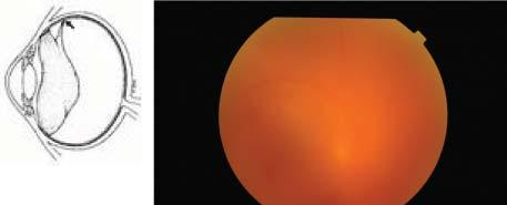 İkinci bir klasik vitrektomi endikasyonu ise traksiyonel ve yırtıklı retina dekolmanlarıdır.