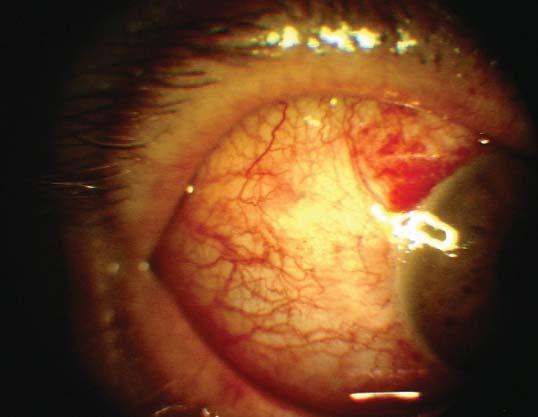 Ret-Vit 2008;16:85-90 Kapran ve ark. 89 Resim 9: Bimanüel 25-gauge sütürsüz vitrektomi uygulanmış PDR li bir olgunun postoperatif 1.günde ön segment fotoğrafları.