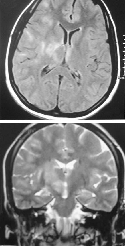Mayda Domaç F, Boylu E, Mısırlı H, Adıgüzel T, MR Findings in Neuro-Behcet s Syndrome Resim 1. Kontrastl kraniyal MRG (aksiyel kesit).