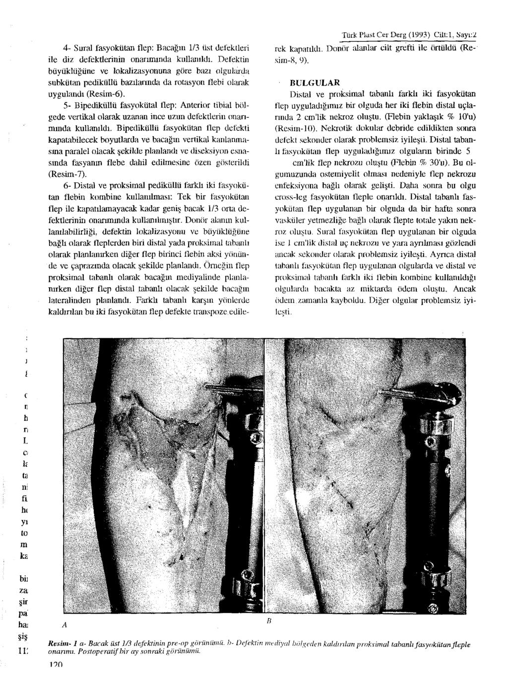 4- Sural fasyokütan flep: Bacağın 1/3 üst defektleri ile diz defektlerinin onarımında kullanıldı.