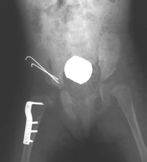 Femoral osteotomiler intertrokanterik bölgeden yapýldý ve osteotomi hattý 4 delikli 1/3 tubuler plakla yada Harris Müller plaðý ile tespit edildi.
