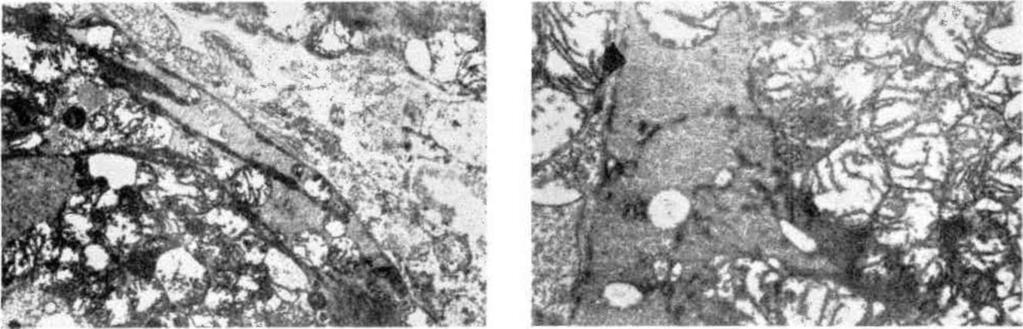 Hematoksilen-eozin, orijinal büyütme x460. Şekil 2. A, Dilate Kardiyomiyopati. Sarkolemma altında ve miyofürıler alanda glikojen birikimi, mitokondrilerde şişme, inîerstisiel kollajende artma.