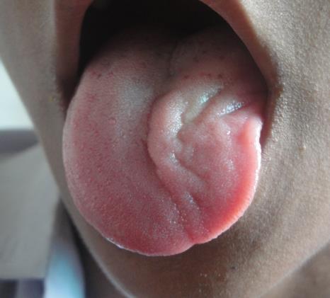 Bu durum, klinik lezyonlarda farklı tabloların oluşmasına neden olur. (1) Şekil 13a. N.hypoglossus N.hypoglossus ile İlgili Klinik Bilgiler: Santral tip paralizi: Supranüklear lezyonlarda olur.