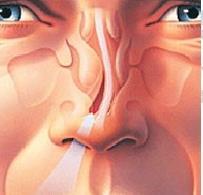 1.AĞIZ SOLUNUMUNA SEBEP OLAN NASAL FAKTÖRLER b) SEPTAL DEVİASYON SEMPTOMLAR Tıkanıklık Sekonder nasal inflamasyon ve enfeksiyon Ağız solunumu Üst solunum