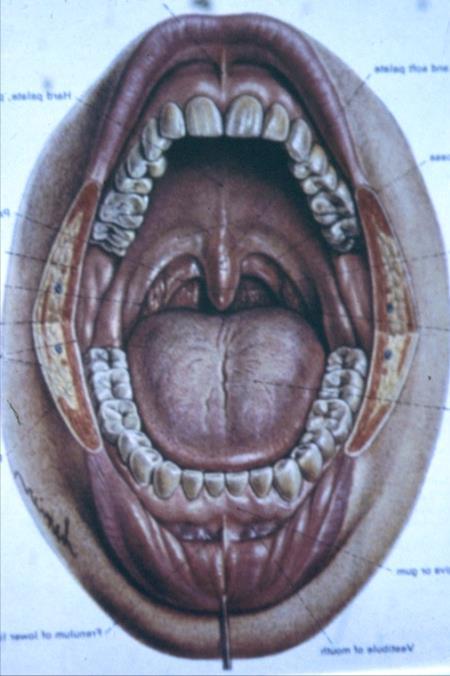 Dil kaidesi posteriorunda lingual tonsiller anormal dil pozisyonuna