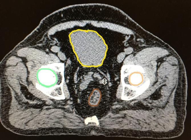 Hazırlık Prostat radyoterapisinde, prostatın komşuluğunda korunması gereken kritik organlar