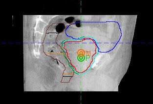 Rektum Mesane Bağırsaklar Femur Başları Bu organları korumak için CT Simülasyon öncesi bir