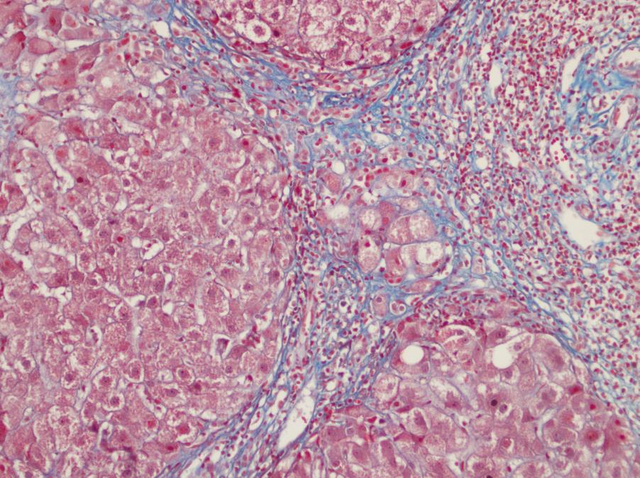 Fibrozis ve rejenerasyon Kronik hepatitli hastaların çoğunda fibröz skar dokusu görülür. Artan fibröz doku portal alanı genişletir ve periportal uzanım gösterir.
