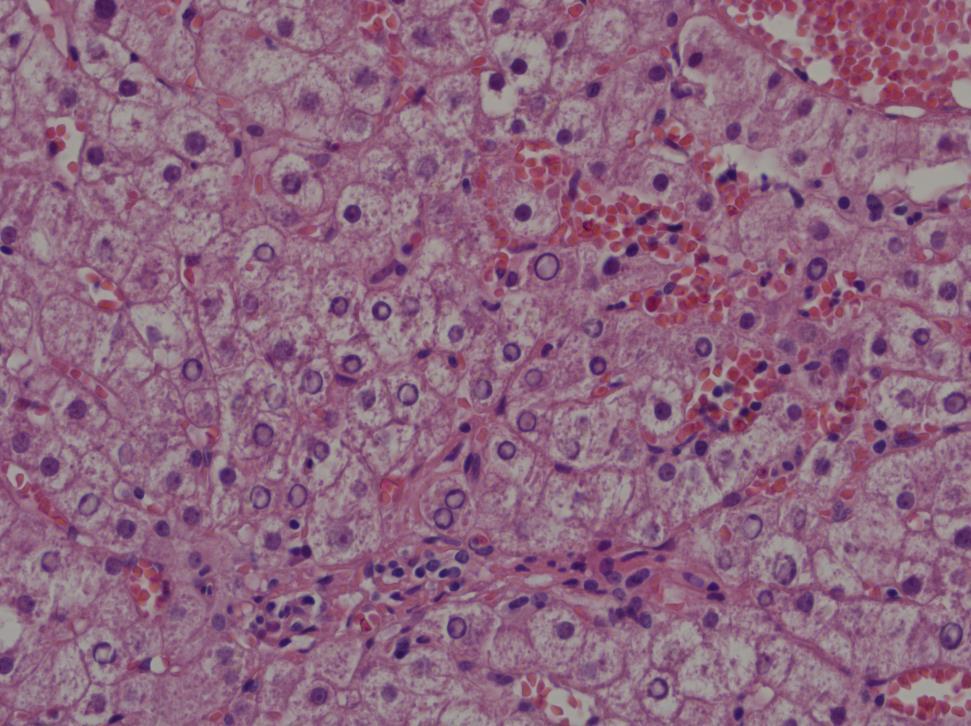 Hepatit B HBcAg in nukleusda birikimi nukleusda kumlu görünüm olarak tariflenen
