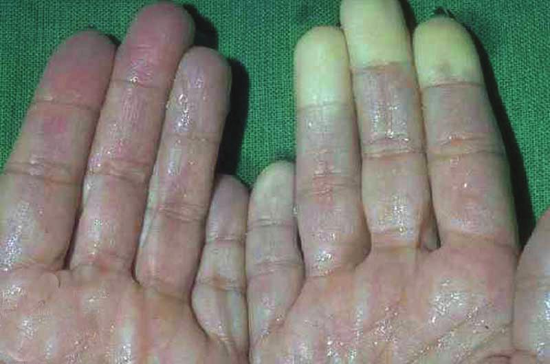 22 ekil 11. El parmaklar nda titre ime maruz kalma nedeni ile olu an kan çekilmesi durumu (Raynaud hastal ) (Anonim, 2008f).