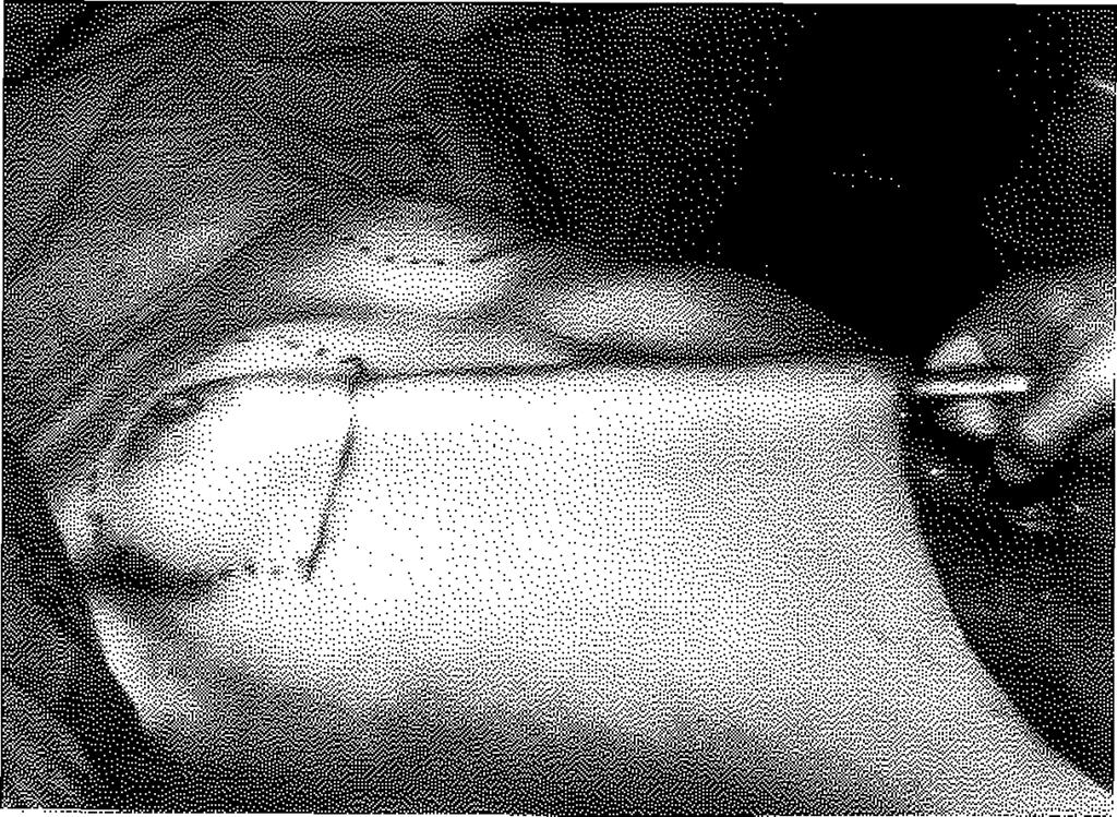 Bu işlem sırasında endoskop kullanılm adı. Boşluğa hemovak dren konularak drenin ucu aksiller deriden dışarı çıkarıldı.