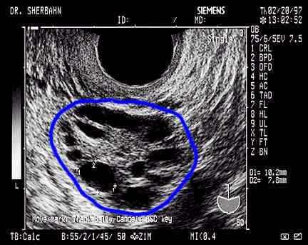 PCOS : OHSS İÇİN MAJOR PREDİSPOZAN FAKTÖR recruitable folikül sayısındaki artış MacDougall et al.,1993; Fauser & Van Heusden et al.,1997 Amso et al.