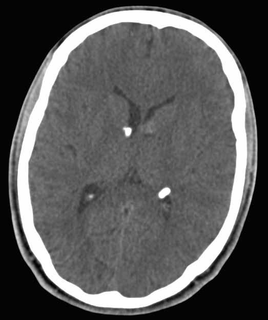 EEG si normal sınırlarda değerlendirildi, kranial BT sinde subependimal kalsifiye nodüller (Şekil 1), sol serebellar hemisferde iki adet kalsifiye lezyon (Şekil 2), her iki lateral ventrikül