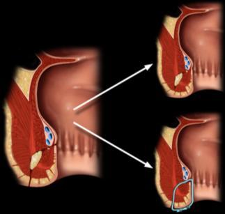 tedavi ve TPN Striktür fibrotik karakterde ise direkt CERRAHİ Parsi, Am J Gastro 2004 Zerbib, APT 2010 2.