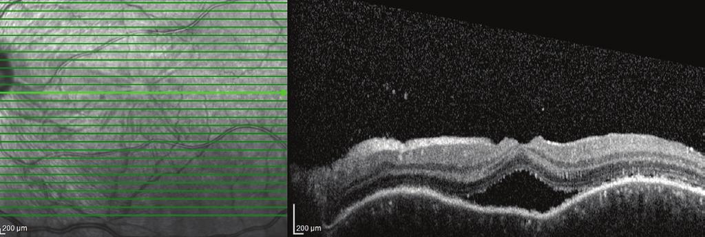 1-4 Granülomatöz panüveit dışında seröz retina dekolmanı, koroidal kalınlaşma, optik diskte hiperemi ve sınırlarında silinme karakteristik göz bulgularıdır.