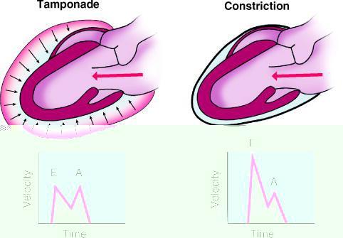 Tamponat da artmış intraperikardiyal basınç nedeniyle diyastolik doluş hem erken, hem geç diyastolde