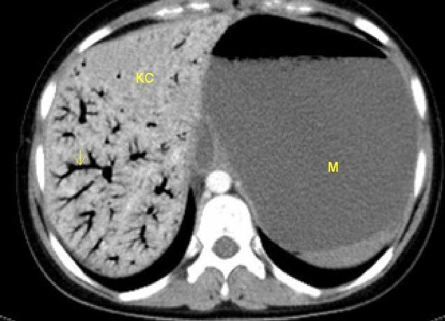 Şekil 3 : Batın tomografisi, Belirgin dilate olmuş mide ve intrahepatik safra yollarında hava görünümü, KC: Karaciğer, M: Mide, Ok: İntrahepatik safra yolunda hava Şekil 4 : Batın tomografisi, Dilate