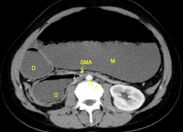 Kısım, M: Mide, D: Duodenum, A: Aorta, SMA: Süperior Mezenterik arter Tartışma ve Sonuç Bu sendrom ilk olarak Rokitansky tarafından bir otopsi olgusunda 1842 de tanımlanmıştır ancak en geniş seriyi