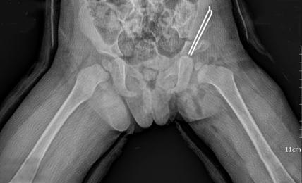[2] Periasetabular Ganz osteotomisi teknik olarak en zor ameliyattır.