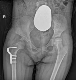 [2,12,27] Chang, Pemberton osteotomisinden sonra erişkinlerde ameliyatlı tarafta sağlam tarafa göre daha fazla eklem yüklenmesi olduğunu saptamıştır; bu nedenle de avasküler nekroz riskinin