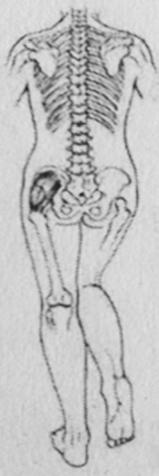Pelvisin artmış öne inklinasyonu ve femur başının arkaya deplasmanı nedeniyle hiperlordoz vardır (Şekil 3). Ördekvari yürüyüş gözlenir.