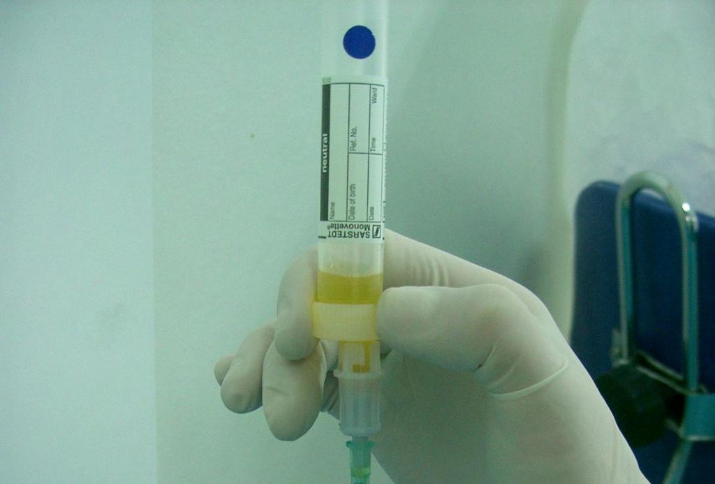 Sarı monovetin içeriğinin üst kısmındaki trombositten fakir plazma