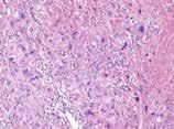 Pathology Department OBJECTİVE: Epithelioid trophoblastic tumor (ETT) is a rare gestational trophoblastic neoplasia with only about 0 reported cases in current literature.