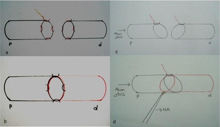 GÜNEYLİ ve ark. anastomozlar 4,5 büyütmeli cerrahi gözlük kullanılarak gerçekleştirildi. İnguinal ligamentin hemen altından medial insizyon uygulandı.