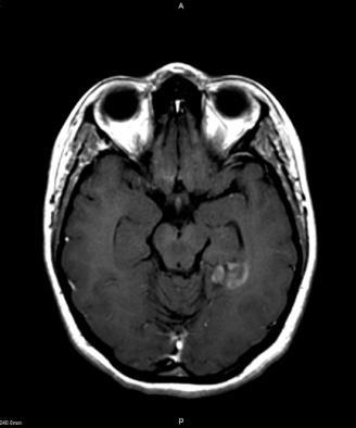 (A) TA görüntüde;sol temporal lob tabanında