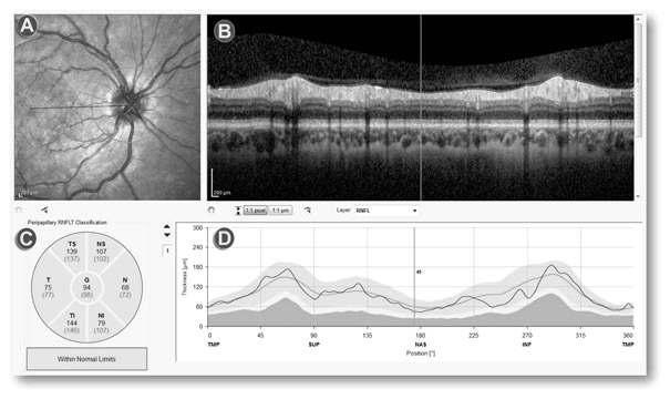 Psikiyatrik Hastalýklar ve Göz: Optik Koherens Tomografinin Psikiyatride Yeri 1. Ganglion hücre aksonlarýndan oluþan retina sinir lifi tabakasý (RSLT), 2.