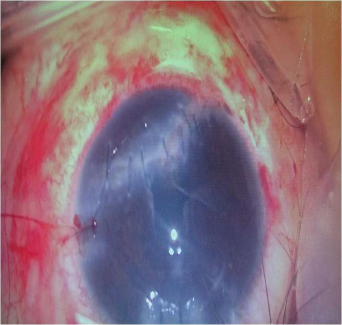 Ayaz Y. ve Türkoğlu E.B. blok ile açı kapanması glokomu dur (11). Pupiller blok ile açı kapanması olan olgular da Nd:YAG lazer iridotomi ve membranektomi yapılabilmektedir.