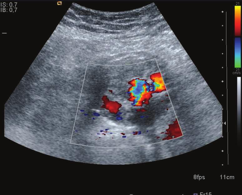 OLGU 4: Resim 16, 17: Transvers planda elde olunan Doppler US