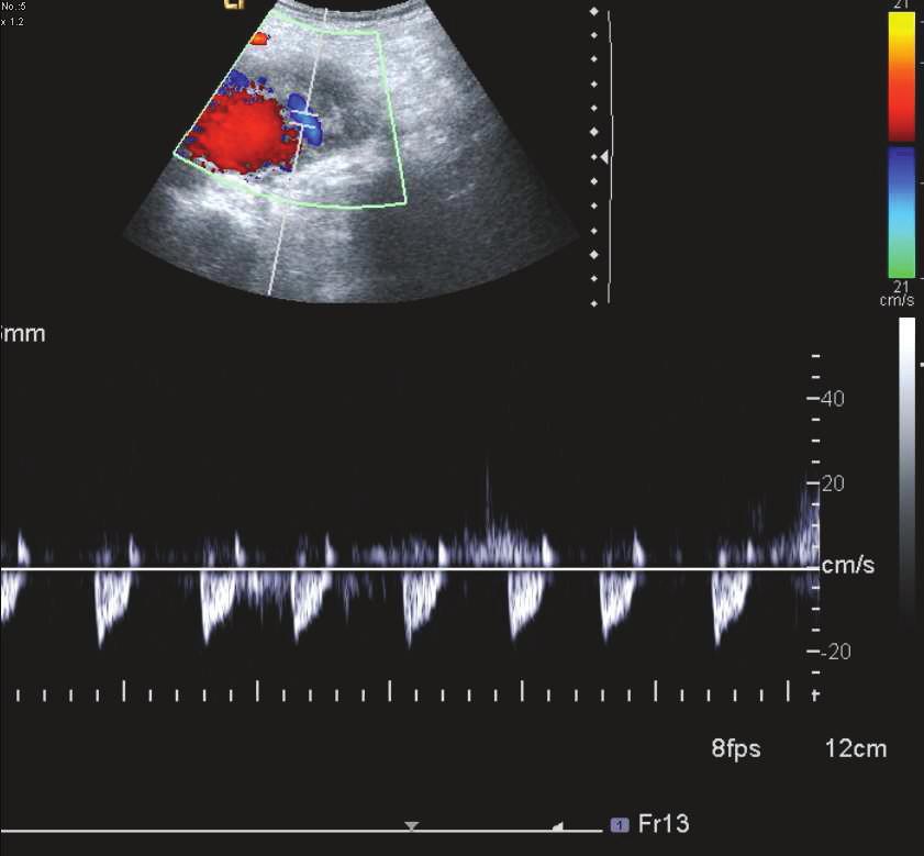 OLGU 5: Resim 19, 20: Transvers planda elde olunan Doppler US görüntüde