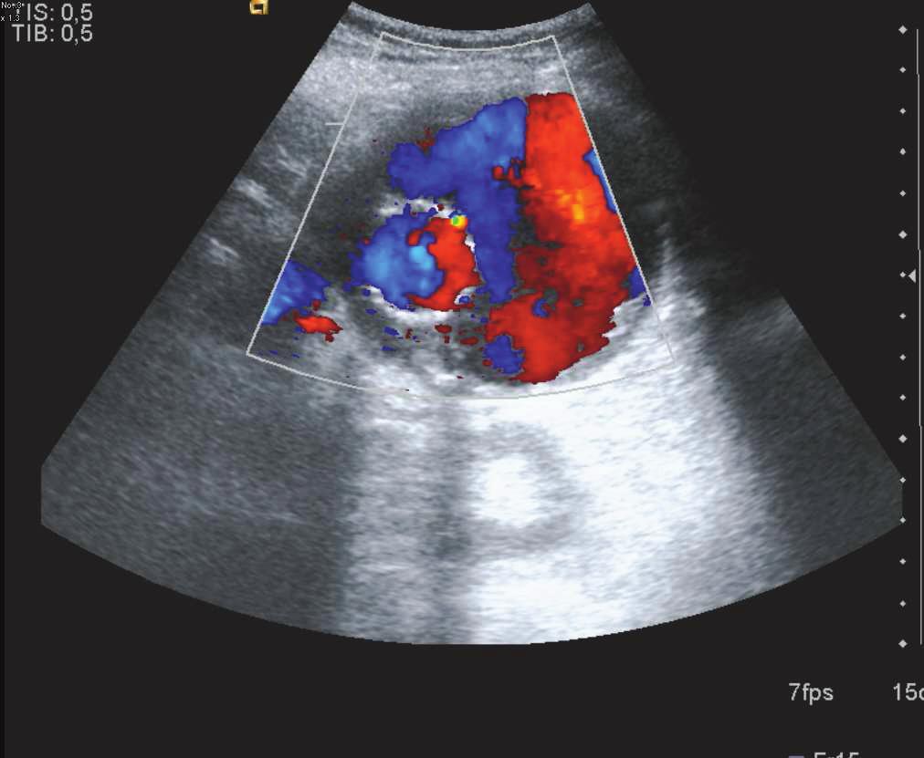 OLGU 6: Resim 22: Transvers planda elde olunan Doppler US görüntüde