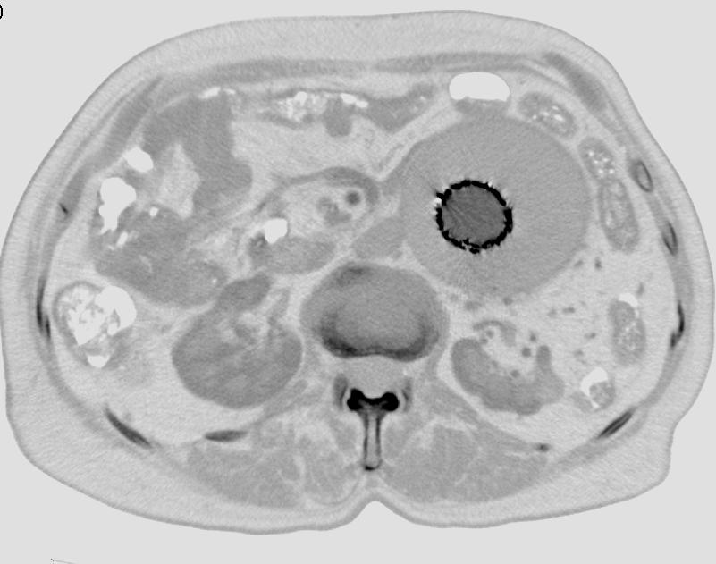 endoleak izlenmemektedir.