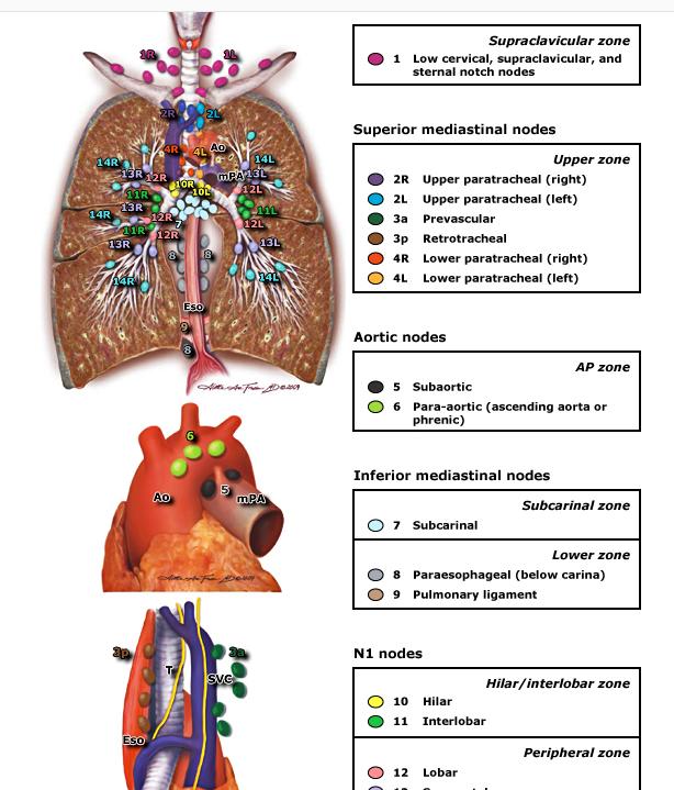 Mediastinal lenf bezi örneklemesi Tüm olgularda sistemik nodal diseksiyon önerilmektedir Sağ: 4,7, 10 Sol 5, 6, 7 Lob spesifik sistemik nodal diseksiyon; periferik yerleşimli T1 tümörde hiler ve