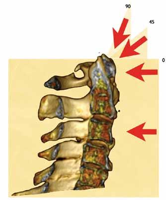 Transvers Ligament Yaralanması Transvers ligament bütün omurgadaki en kalın ve en güçlü ligamenttir. Çoğunlukla dens etrafındaki C1 i sınırlandırmaktadır.