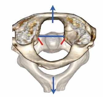 Transvers ligamentin bozulma mekanizması invitro testlerde analiz edilmiştir (7, 23).