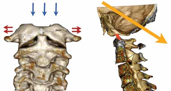 Atlas Kırıklarının Biyomekanik Etkileri Atlas kırıklarına yönelik yapılan deneysel laboratuvar çalışmalarında atlas kırığının tipik olarak kompresif yaralanmalardan kaynaklandığı görülmektedir (Şekil