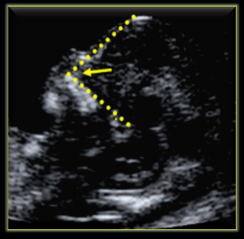 Fetal yüz açısı ölçümünde gebelik haftası 11 +0-13 +6 ve CRL 45-84 mm arasında olmalıdır Görüntü baş ve üst göğüs kafesi tüm