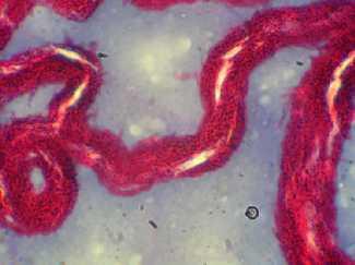 tuberculosis kompleks saptandı 31.