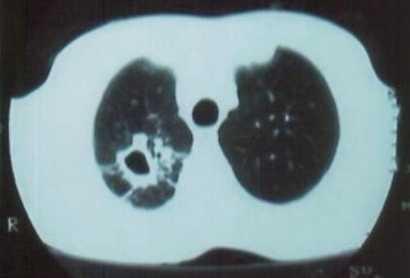 Fizik bakı ve rutin laboratuvar inceleme sonuçları normal Akciğer grafisinde; Sağ akciğer üst zonda 3x3 cm boyutunda, kaviter lezyon izleniyor Toraks BT de; Sağ