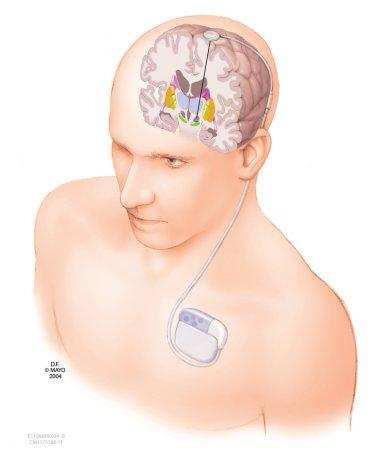Şekil-2 Derin Beyin Stimülasyonunun Yerleşimi düzelmesini sağlayarak motor aktivitelerde iyileşme sağladığı düşünülmektedir.