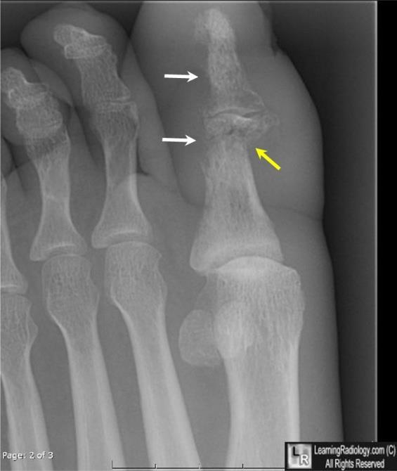 Kemik doku örneği-osteomyelit Osteomyelit; kemik doku aspirasyon kültürü;%87 duyarlılık, %93 özgüllük Kemik doku biyopsisi; kültür için 3-6 adet alınmalı Kültür