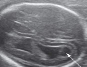 Fetal Enfeksiyonlar TORCH, parvovirus Toxo, CMV Gliosis-tıkanıklık Enfekte debrid-tıkanıklık Serebral atrofi %10-20 Ağır VM (Graham et al., 2001; Gaglioti et al.