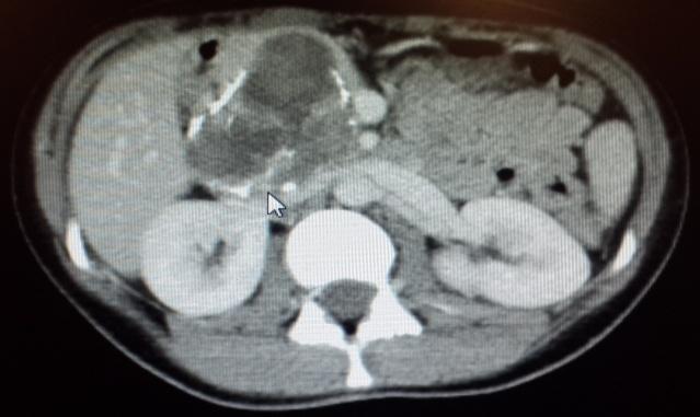 Şekil 1 : Preoperatif BT görüntüleme Şekil 2 : Preoperatif BT görüntüleme Hastanın abdomen ultrasonography (USG) sinde karaciğer, safra kesesi ve pankreas baş kesimi ve mide