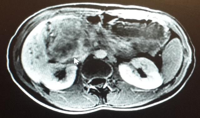 Şekil 3 : Preoperatif MR görüntüleme Şekil 4 : Preoperatif MR görüntüleme Hastaya girişimsel radyoloji tarafından biyopsi yapılması planlandı.